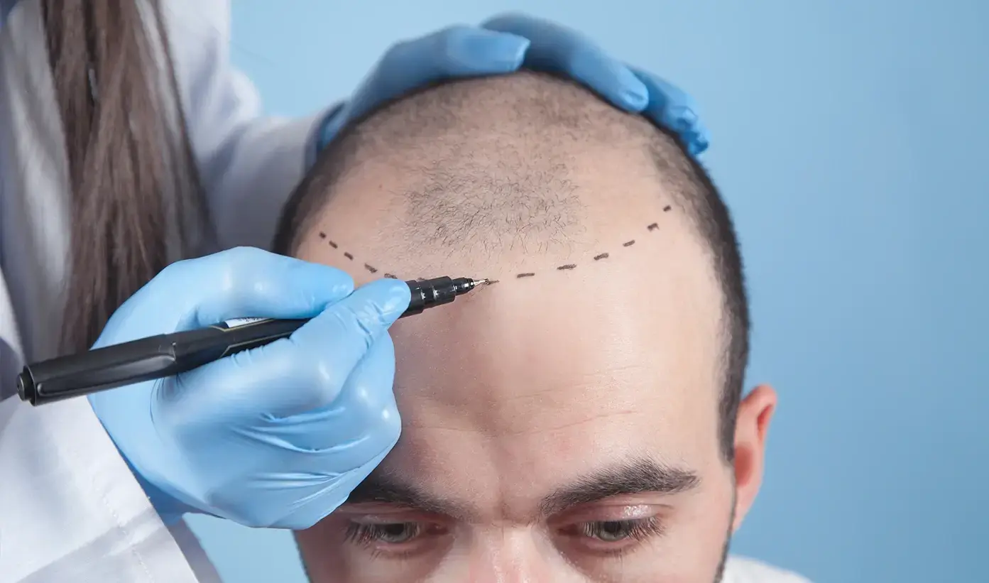 Hair Transplant